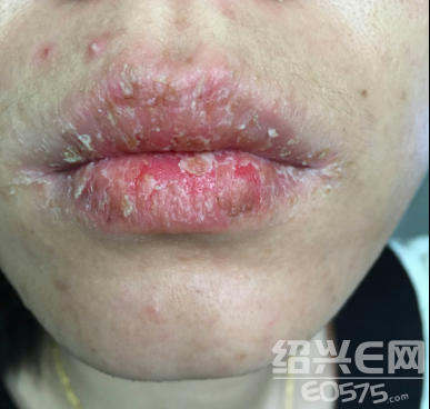 纽约纽约婚纱摄影,化妆品导致嘴唇溃烂