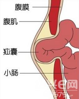 器通过腹股沟区(腹壁与大腿交界的三角区)的缺损向体表突出所形成的疝